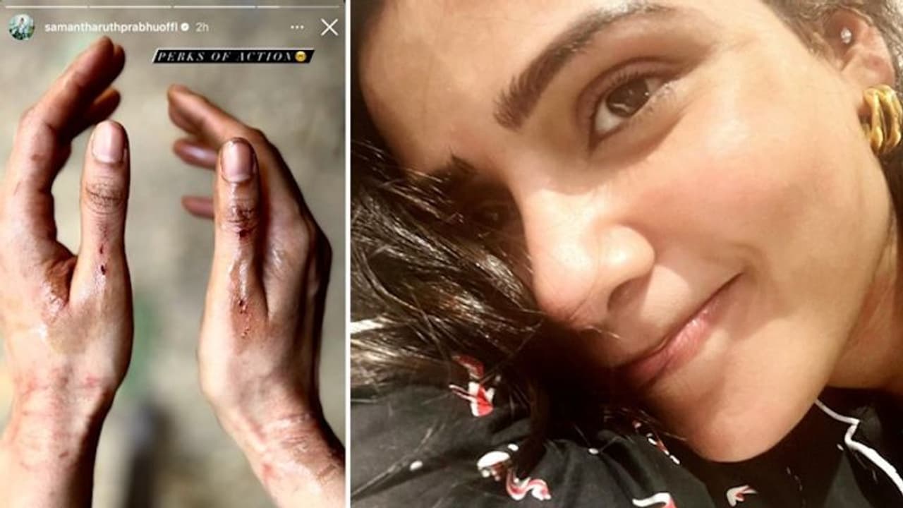 Did Samantha Ruth Prabhu get wounded on the sets of Citadel India? Check out picture Did Samantha Ruth Prabhu get wounded on the sets of Citadel India? Check out picture