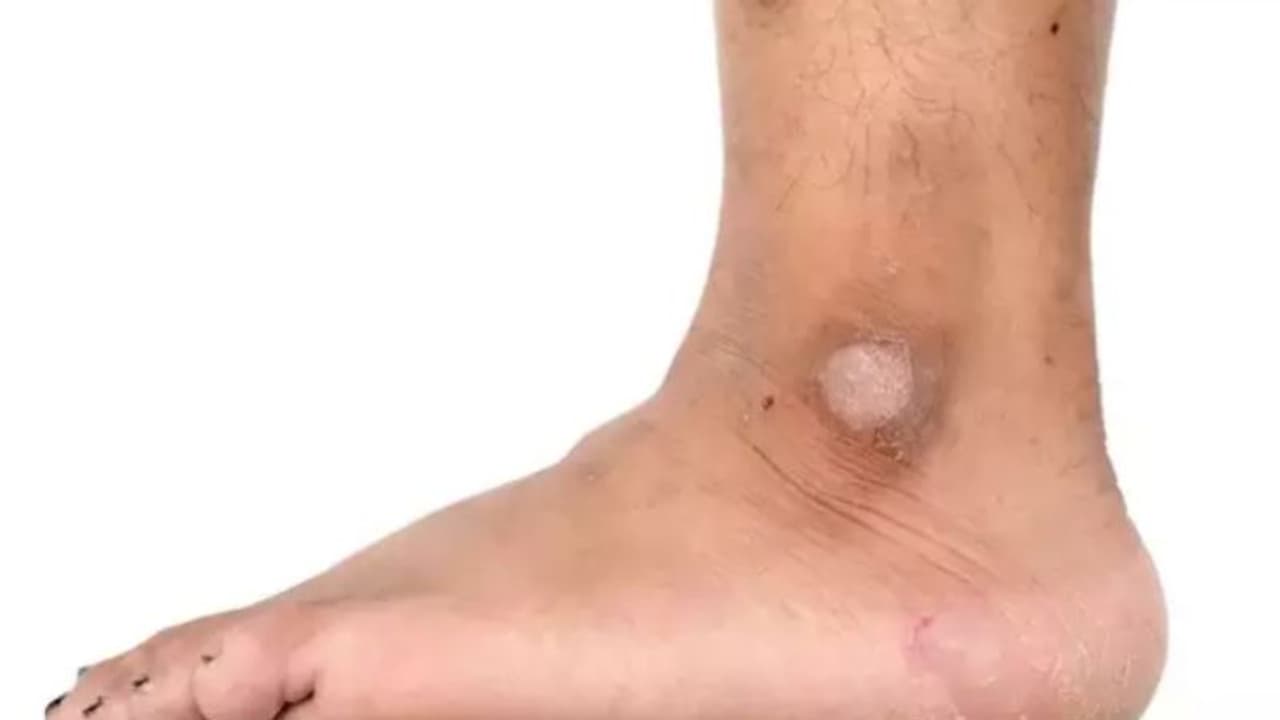 Health Tip : കാലില് നിറവ്യത്യാസവും പാടുകളും കാഴ്ചയ്ക്ക് മങ്ങലും; തിരിച്ചറിയാം ഈ പ്രശ്നത്തെ... Health Tip : കാലില് നിറവ്യത്യാസവും പാടുകളും കാഴ്ചയ്ക്ക് മങ്ങലും; തിരിച്ചറിയാം ഈ പ്രശ്നത്തെ...