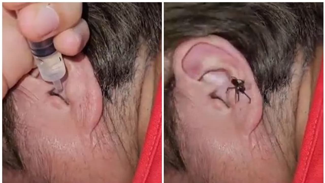 ವ್ಯಕ್ತಿಯ ಕಿವಿಯಿಂದ ಹೊರಬಂತು ಜೇಡ, ವಿಡಿಯೋ ನೋಡಿ ದಂಗಾದ ಜನ!