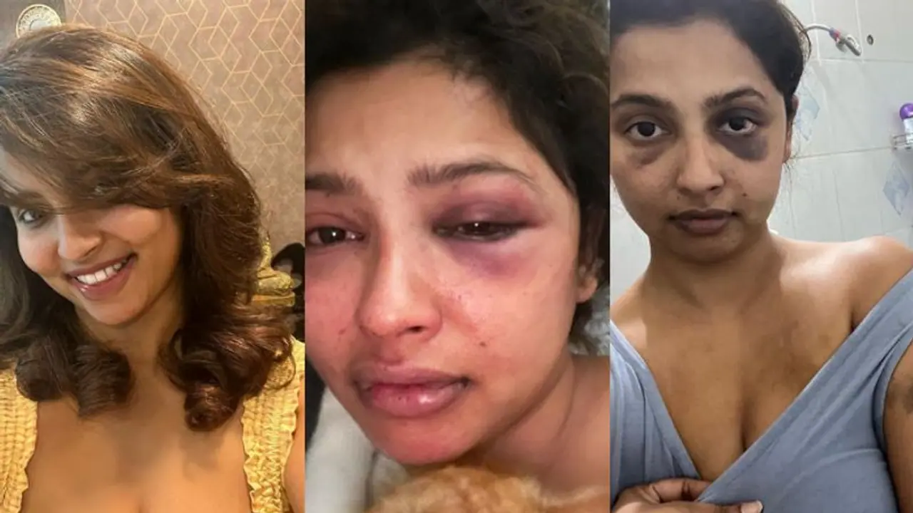 Malayalam actress Anicka Vikhraman claims ex boyfriend Anoop Pillai assaulted her; pictures go viral