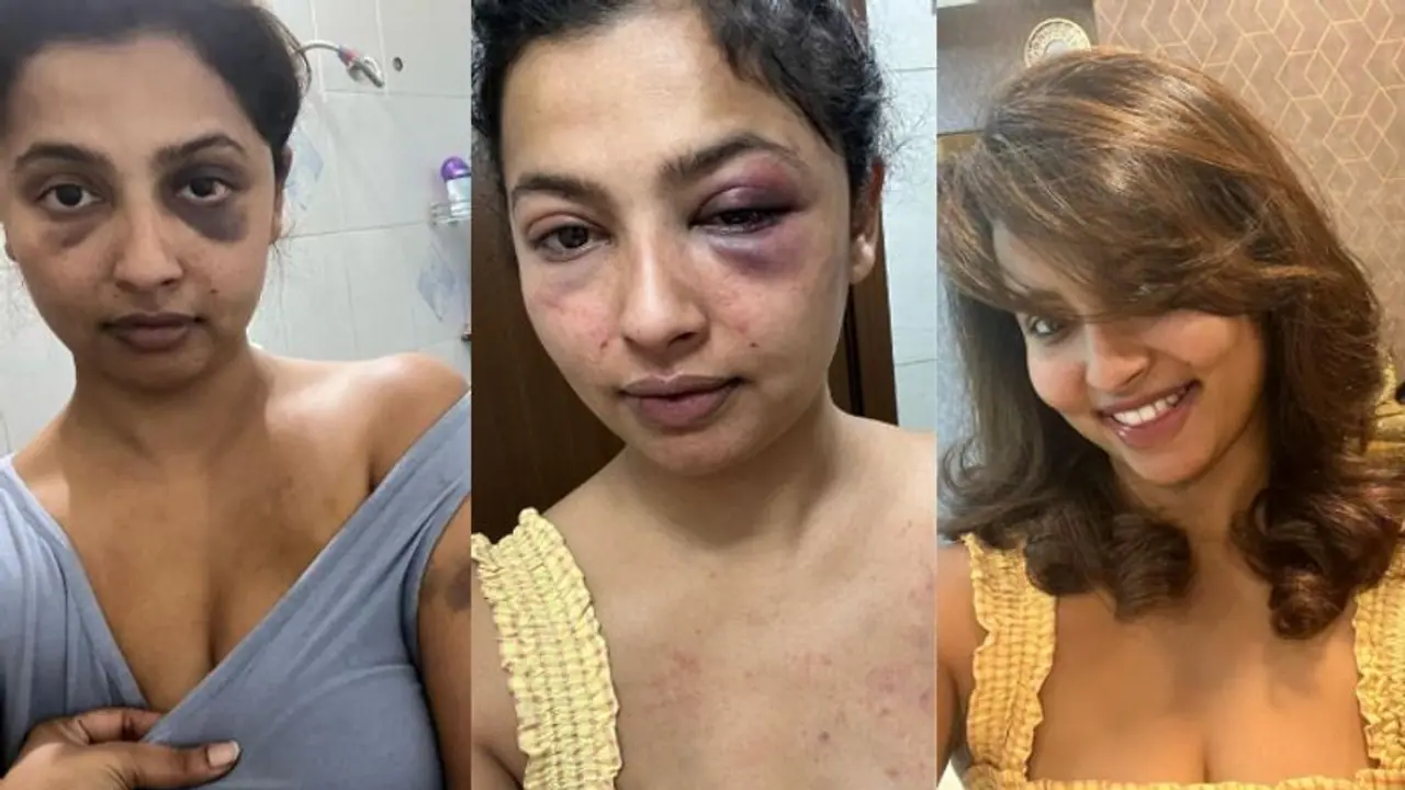 ಮಾಜಿ ಪ್ರಿಯತಮನಿಂದ ಚಿತ್ರಹಿಂಸೆ, ಹಲ್ಲೆ; ಫೋಟೋ ಶೇರ್ ಮಾಡಿ ಭಯಾನಕ ಘಟನೆ ಬಿಚ್ಚಟ್ಟ ನಟಿ ಅನಿಕಾ ಮಾಜಿ ಪ್ರಿಯತಮನಿಂದ ಚಿತ್ರಹಿಂಸೆ, ಹಲ್ಲೆ; ಫೋಟೋ ಶೇರ್ ಮಾಡಿ ಭಯಾನಕ ಘಟನೆ ಬಿಚ್ಚಟ್ಟ ನಟಿ ಅನಿಕಾ