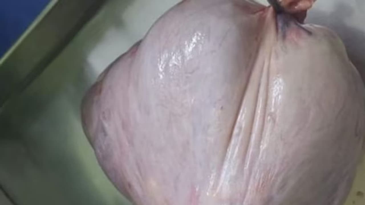 ಮಹಿಳೆಯ ಹೊಟ್ಟೆಯಲ್ಲಿತ್ತು 8 ಕೆಜಿ ಗಡ್ಡೆ: ವೈದ್ಯರಿಂದ ಯಶಸ್ವಿ ಶಸ್ತ್ರಚಿಕಿತ್ಸೆ 