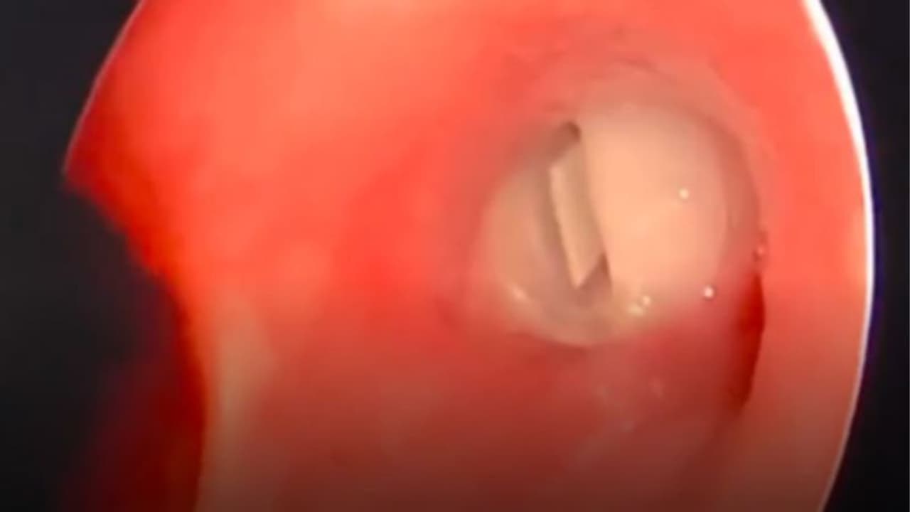 നാല് വയസുകാരന്റെ തൊണ്ടയില് കുടുങ്ങിയ 'വിസില്' വിജയകരമായി പുറത്തെടുത്തു നാല് വയസുകാരന്റെ തൊണ്ടയില് കുടുങ്ങിയ 'വിസില്' വിജയകരമായി പുറത്തെടുത്തു