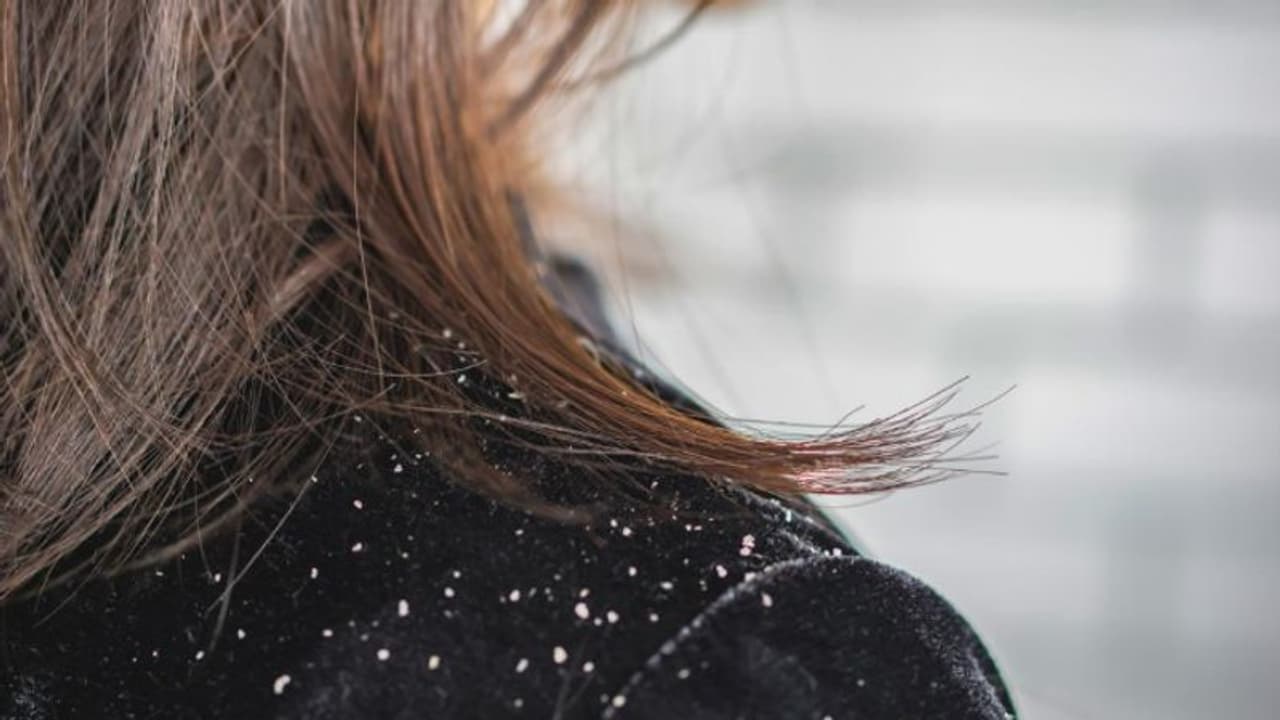 തലമുടി കൊഴിച്ചിലും താരനും കുറയ്ക്കാൻ പരീക്ഷിക്കാം ഈ നാല് ഹെയർ പാക്കുകൾ... തലമുടി കൊഴിച്ചിലും താരനും കുറയ്ക്കാൻ പരീക്ഷിക്കാം ഈ നാല് ഹെയർ പാക്കുകൾ...