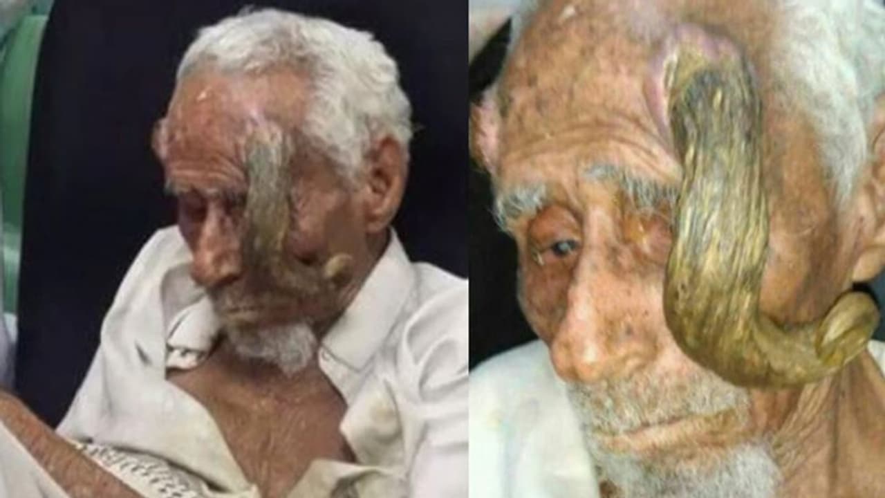 തലയില് കൊമ്പിന് സമാനമായ വളര്ച്ച; നീക്കം ചെയ്യാനുള്ള ശ്രമം വൃദ്ധന്റെ ജീവനെടുത്തതായി ബന്ധുക്കള് തലയില് കൊമ്പിന് സമാനമായ വളര്ച്ച; നീക്കം ചെയ്യാനുള്ള ശ്രമം വൃദ്ധന്റെ ജീവനെടുത്തതായി ബന്ധുക്കള്