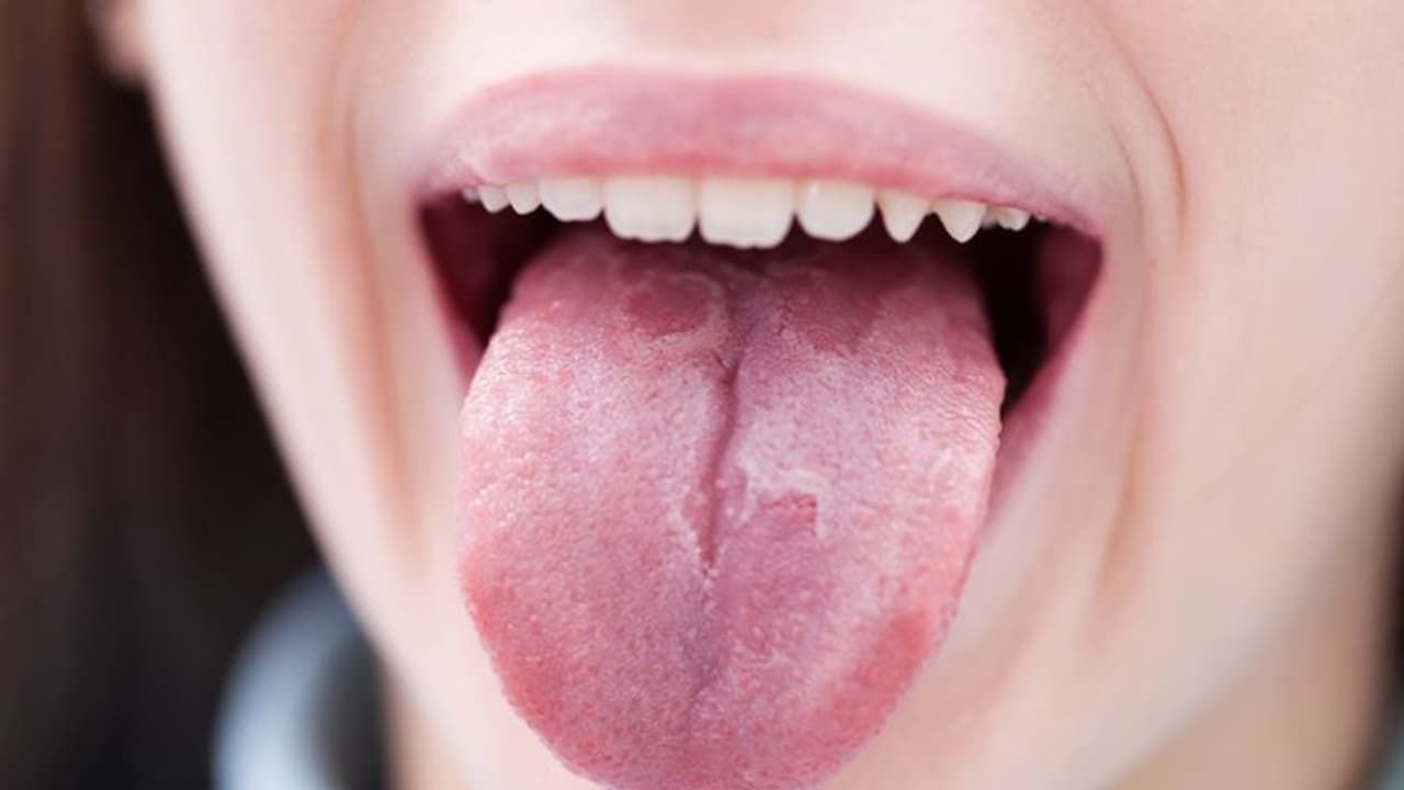 നാവില് വെളുത്ത പാടുകള്, വായിലോ കഴുത്തിലോ ചെറിയ വീക്കം; തിരിച്ചറിയൂ ഈ ലക്ഷണങ്ങളെ... നാവില് വെളുത്ത പാടുകള്, വായിലോ കഴുത്തിലോ ചെറിയ വീക്കം; തിരിച്ചറിയൂ ഈ ലക്ഷണങ്ങളെ...