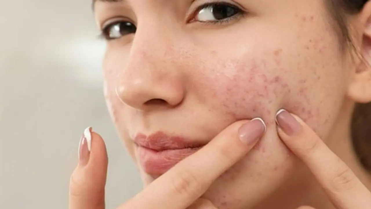 മുഖക്കുരു ഉണ്ടാകുമ്പോള് ഇക്കാര്യങ്ങള് ചെയ്യാറുണ്ടോ? എങ്കില് ശ്രദ്ധിക്കുക.... മുഖക്കുരു ഉണ്ടാകുമ്പോള് ഇക്കാര്യങ്ങള് ചെയ്യാറുണ്ടോ? എങ്കില് ശ്രദ്ധിക്കുക....