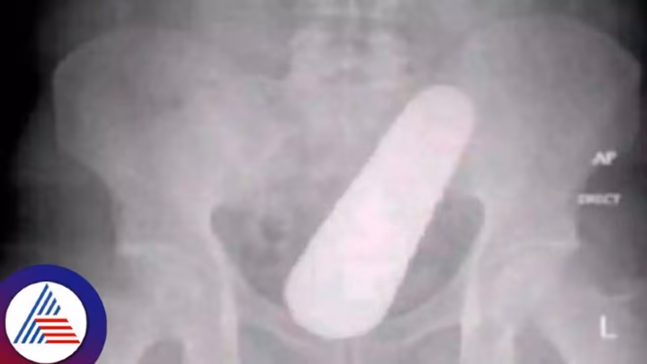 ಗುದನಾಳದಲ್ಲಿ ಸಿಲುಕಿತ್ತು ಸೌತೆಕಾಯಿ, ಬೀಜ ತಿಂದಿದ್ದೆ ಎಂದ ವ್ಯಕ್ತಿ, ದಂಗಾದ ವೈದ್ಯರು!