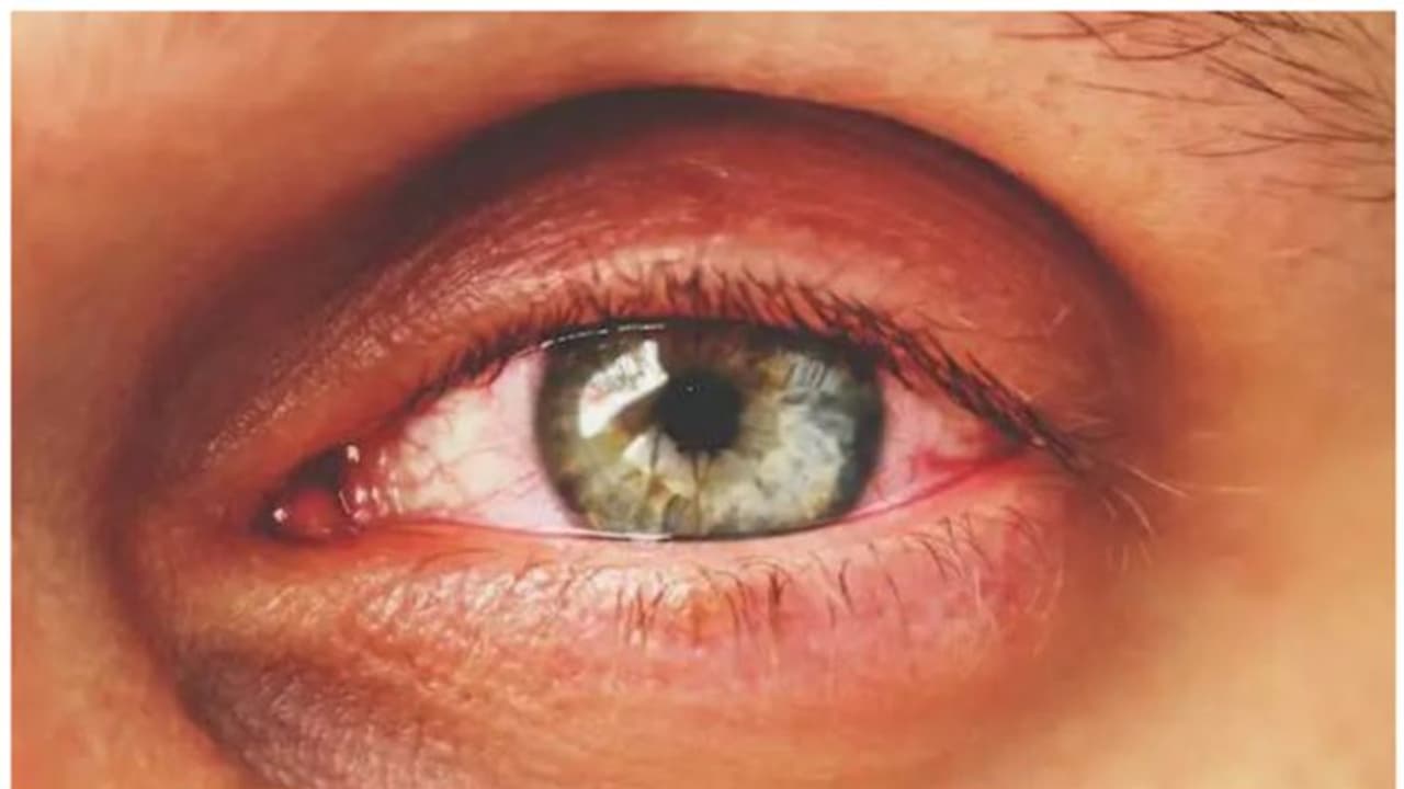 എന്താണ് തൈറോയ്ഡ് നേത്ര രോഗം? കൂടുതലറിയാം എന്താണ് തൈറോയ്ഡ് നേത്ര രോഗം? കൂടുതലറിയാം