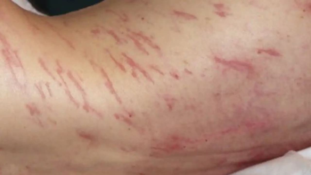 ചര്മ്മത്തിന് അകത്ത് പുഴുവരിക്കുന്നു; അപൂര്വ രോഗാവസ്ഥയുമായി ഒരാള്... ചര്മ്മത്തിന് അകത്ത് പുഴുവരിക്കുന്നു; അപൂര്വ രോഗാവസ്ഥയുമായി ഒരാള്...