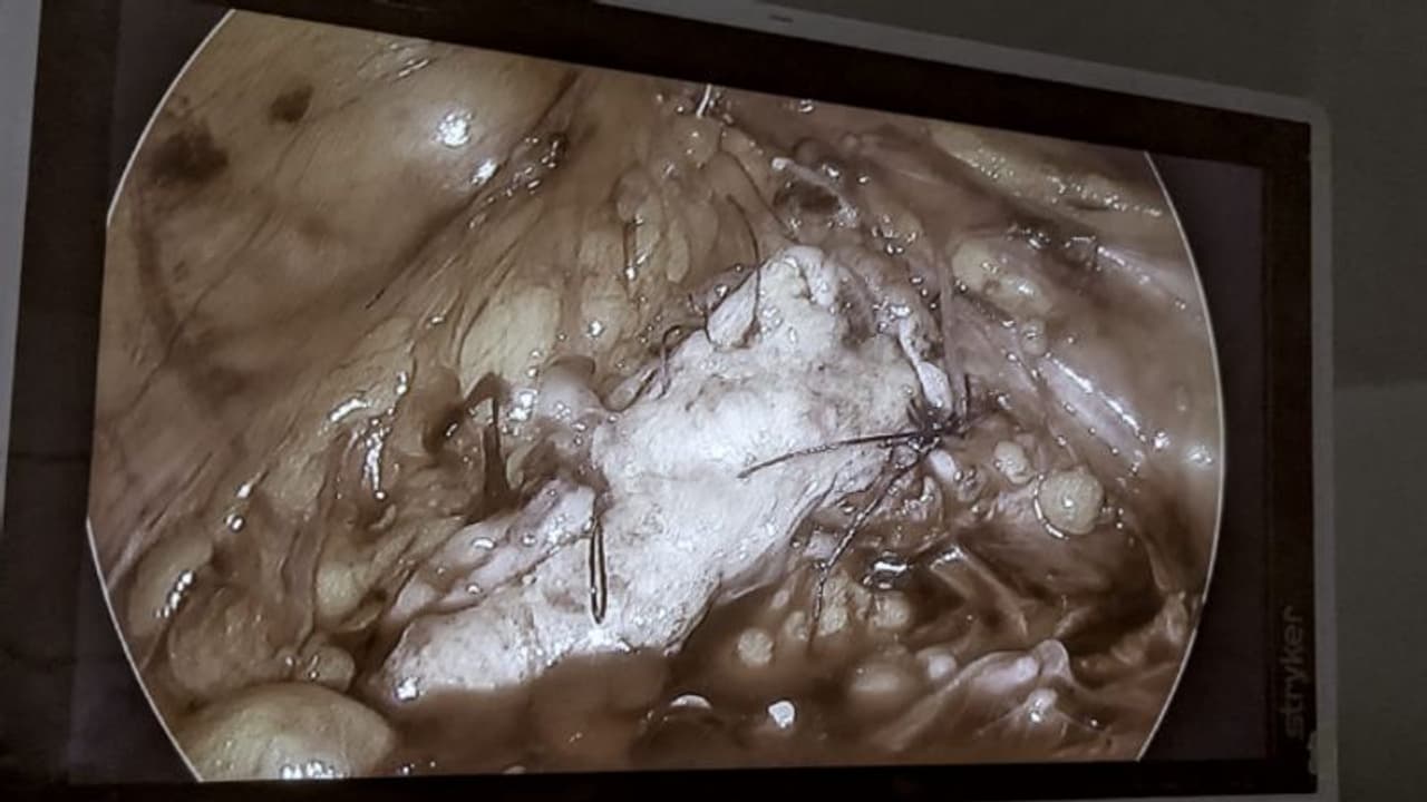 മൂത്രനാളിയിൽപ്രശ്നം, ആശുപത്രിയിലെത്തി, വായ്ക്കുള്ളിലെ തൊലി ഉപയോഗിച്ച് കൃത്രിമ മൂത്രനാളി സൃഷ്ടിച്ച് ശസ്ത്രക്രിയ