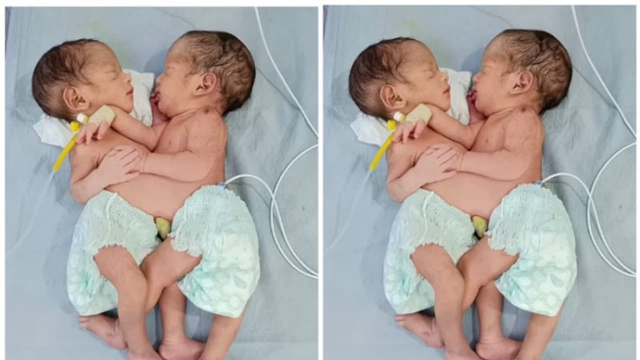 ശരീരം രണ്ട് പക്ഷേ വയര് ഒന്ന്; ഇന്ത്യയില് അപൂര്വ്വ ഇരട്ടകള് ജനിച്ചു, കുട്ടികള് ആരോഗ്യത്തോടെ ഇരിക്കുന്നു ശരീരം രണ്ട് പക്ഷേ വയര് ഒന്ന്; ഇന്ത്യയില് അപൂര്വ്വ ഇരട്ടകള് ജനിച്ചു, കുട്ടികള് ആരോഗ്യത്തോടെ ഇരിക്കുന്നു