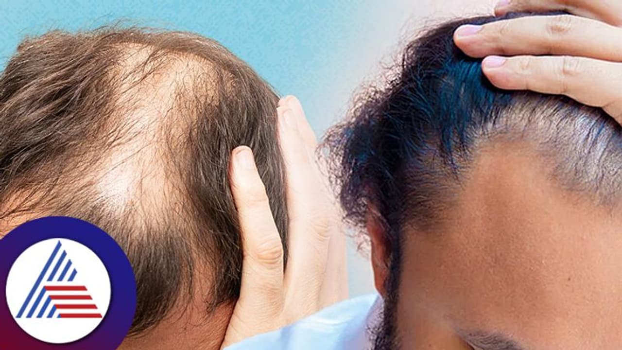 ಪುರುಷರಿಗೇಕೆ ಬೇಗ ಬಾಲ್ಡ್ ಆಗುತ್ತೆ? ಏನಾದ್ರೂ ಪರಿಹಾರವಿದ್ಯಾ? ಪುರುಷರಿಗೇಕೆ ಬೇಗ ಬಾಲ್ಡ್ ಆಗುತ್ತೆ? ಏನಾದ್ರೂ ಪರಿಹಾರವಿದ್ಯಾ?