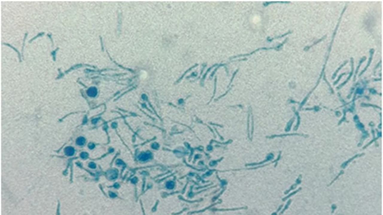 முதல் முறையாக மனிதருக்குப் பரவிய தாவரப் பூஞ்சை நோய்! மருத்துவர்கள் அதிர்ச்சி! முதல் முறையாக மனிதருக்குப் பரவிய தாவரப் பூஞ்சை நோய்! மருத்துவர்கள் அதிர்ச்சி!