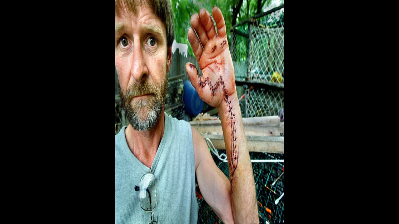 Flesh eating bacteria Vibrio vulnificus