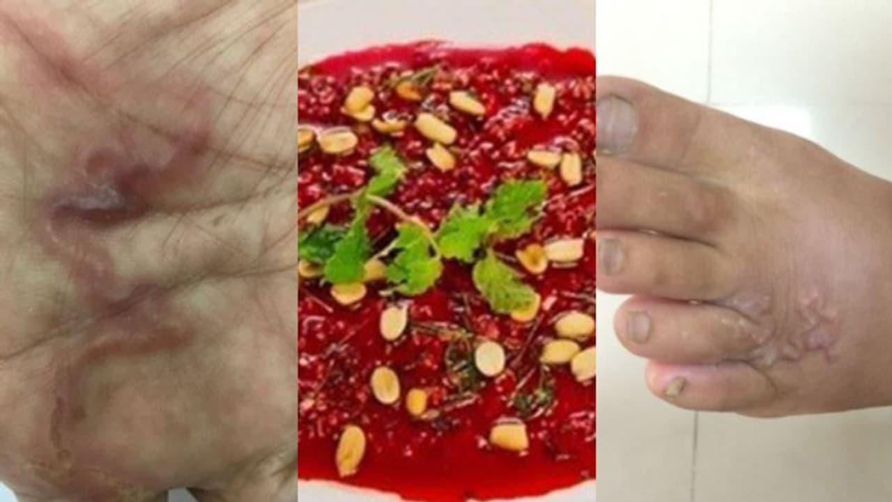 തൊലിക്ക് അടിയിലൂടെയും തലച്ചോറിലും ഇഴഞ്ഞ് നടക്കുന്ന നിലയില് വിരകള്, 58കാരിയെ അപകടാവസ്ഥയിലാക്കി ഈ വിഭവം തൊലിക്ക് അടിയിലൂടെയും തലച്ചോറിലും ഇഴഞ്ഞ് നടക്കുന്ന നിലയില് വിരകള്, 58കാരിയെ അപകടാവസ്ഥയിലാക്കി ഈ വിഭവം