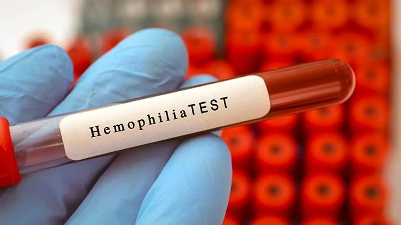 What is Hemophilia? Know about the genetic disorder, complications and to manage common co occurring condition What is Hemophilia? Know about the genetic disorder, complications and to manage common co occurring condition