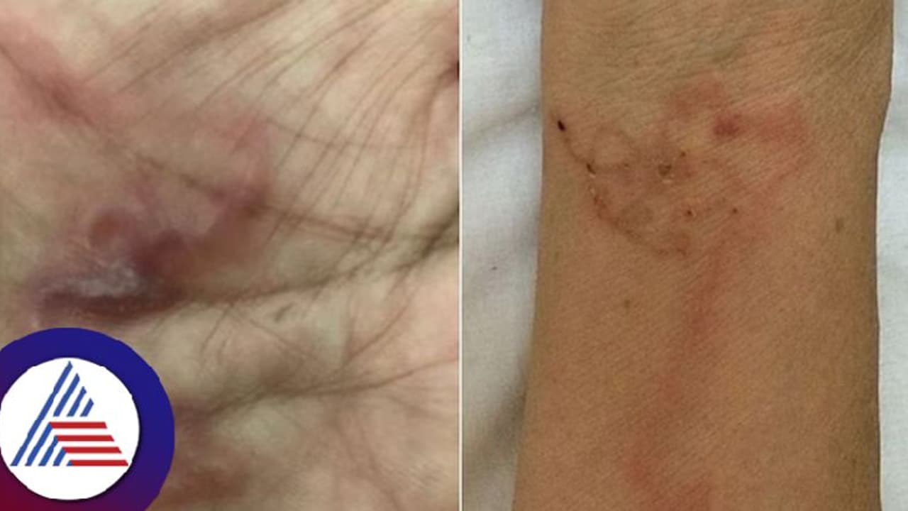 ಹಸಿ ರಕ್ತದ ಪುಡ್ಡಿಂಗ್ ತಿಂದ ಮಹಿಳೆ, ಮೆದುಳು ಸೇರಿತ್ತು ಹುಳುಗಳ ರಾಶಿ! ಹಸಿ ರಕ್ತದ ಪುಡ್ಡಿಂಗ್ ತಿಂದ ಮಹಿಳೆ, ಮೆದುಳು ಸೇರಿತ್ತು ಹುಳುಗಳ ರಾಶಿ!