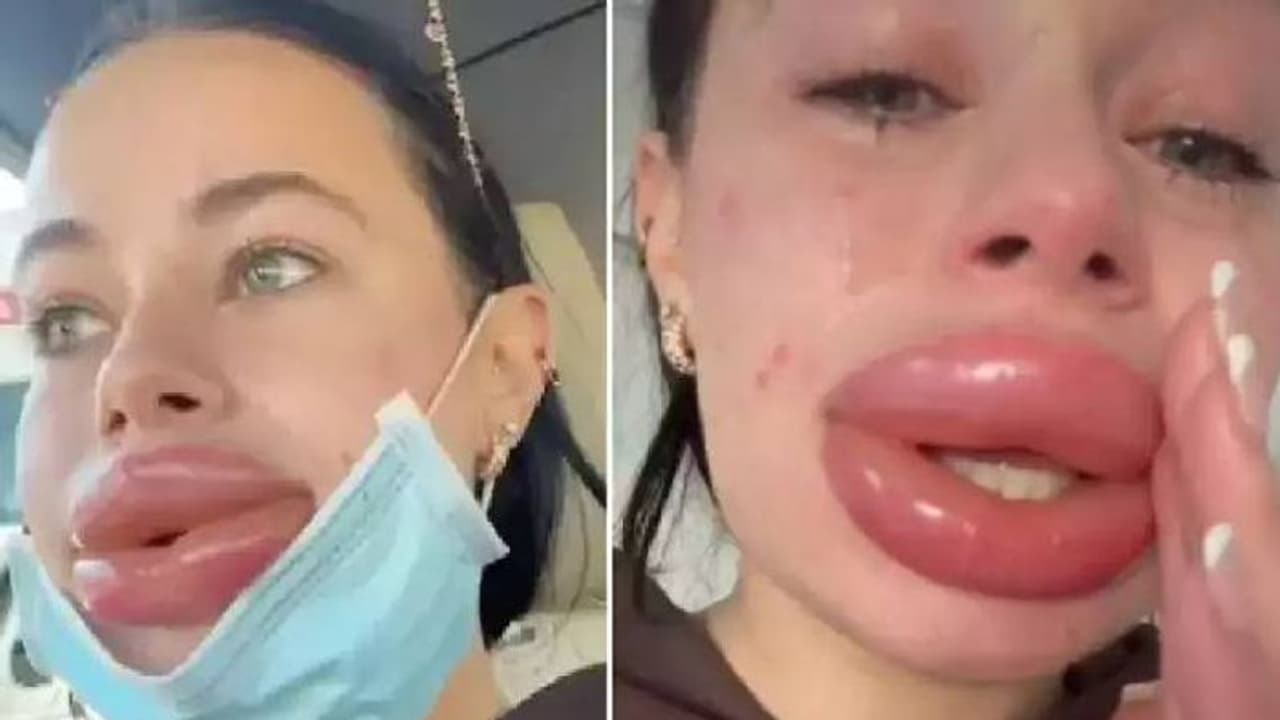 ഭം​ഗി വർധിപ്പിക്കാൻ സൗജന്യ കോസ്മെറ്റിക് ചികിത്സ, ചുണ്ടുകൾ വീർത്തുവന്നു, ദുരനുഭവം വെളിപ്പെടുത്തി യുവതി