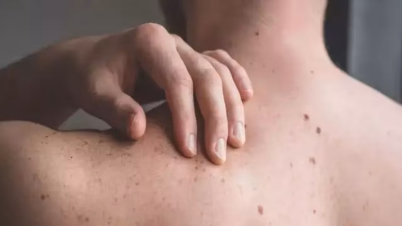 സ്കിൻ ക്യാൻസര്‍ കേസുകള്‍ കൂടിയതിന് പിന്നാലെ ജനങ്ങള്‍ക്ക് വേണ്ടി നെതര്‍ലാൻഡ്സ് ചെയ്തത്...