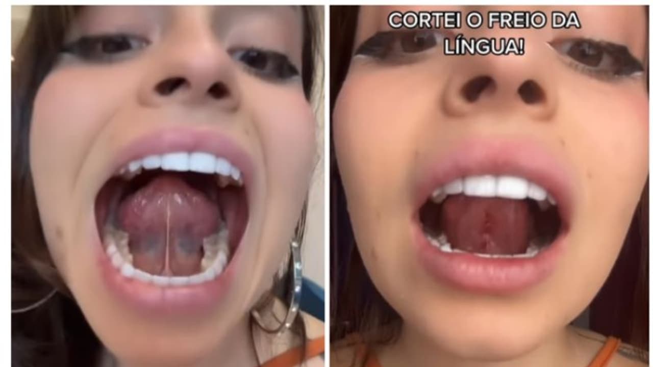 'നന്നായി ചുംബിക്കണം'; നാക്കിന് താഴത്തെ ടിഷ്യു നീക്കം ചെയ്ത് യുവതി 