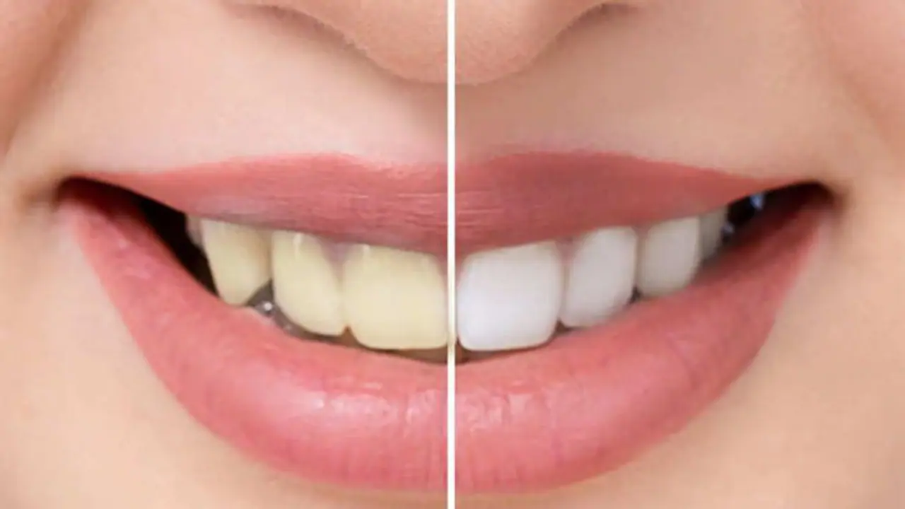 പല്ലിലെ കറ മാറ്റാന് പരീക്ഷിക്കാം ഈ എട്ട് വഴികള്... പല്ലിലെ കറ മാറ്റാന് പരീക്ഷിക്കാം ഈ എട്ട് വഴികള്...