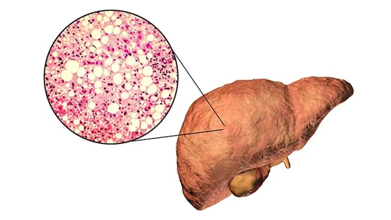 Can a skinny person suffer from fatty liver disease? Read this NOW Can a skinny person suffer from fatty liver disease? Read this NOW
