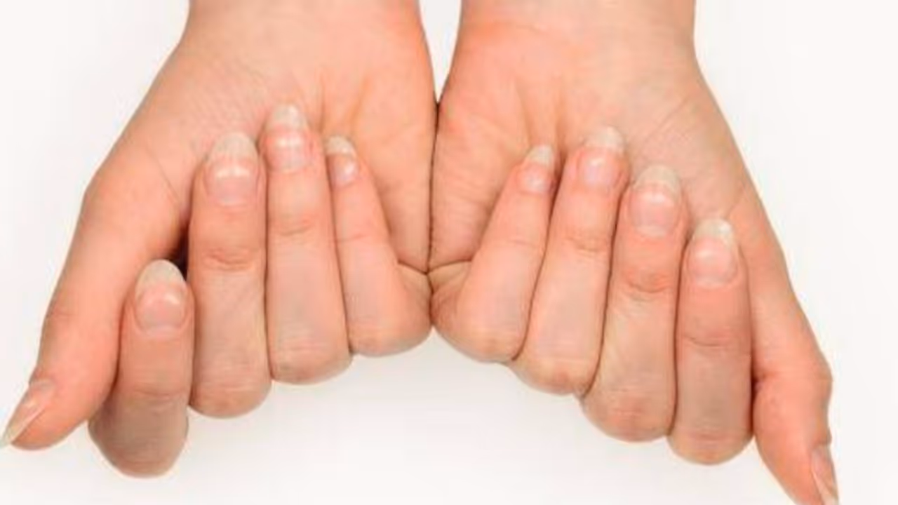 വരണ്ട ചര്മ്മം, കേടായ പല്ലുകളും നഖങ്ങളും; തിരിച്ചറിയാം ഈ ആരോഗ്യപ്രശ്നം... വരണ്ട ചര്മ്മം, കേടായ പല്ലുകളും നഖങ്ങളും; തിരിച്ചറിയാം ഈ ആരോഗ്യപ്രശ്നം...