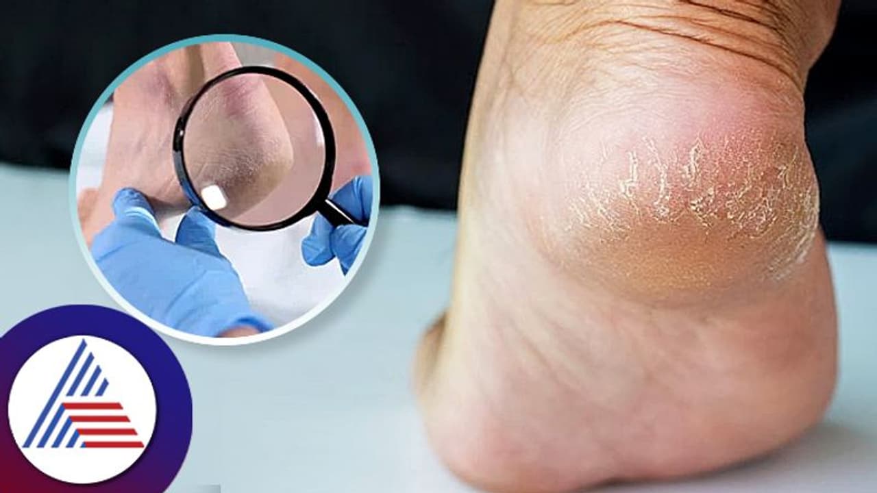 Beauty Tips : ಬೇಸಿಗೆಯಲ್ಲಿ ಹಿಮ್ಮಡಿ ಒಡೆಯುವುದೇಕೆ? Beauty Tips : ಬೇಸಿಗೆಯಲ್ಲಿ ಹಿಮ್ಮಡಿ ಒಡೆಯುವುದೇಕೆ?