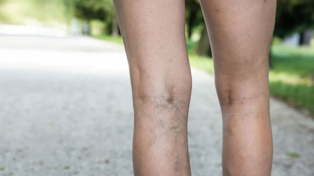 വെരിക്കോസ് വെയിന്‍; ശ്രദ്ധിക്കാം ഈ കാര്യങ്ങള്‍... 