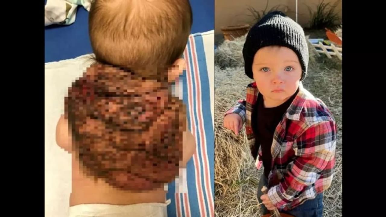 മുതുകില്‍ ആമയുടെ പുറംതോട് പോലത്തെ വളര്‍ച്ച; അപൂര്‍വ രോഗം ബാധിച്ച കുഞ്ഞ്