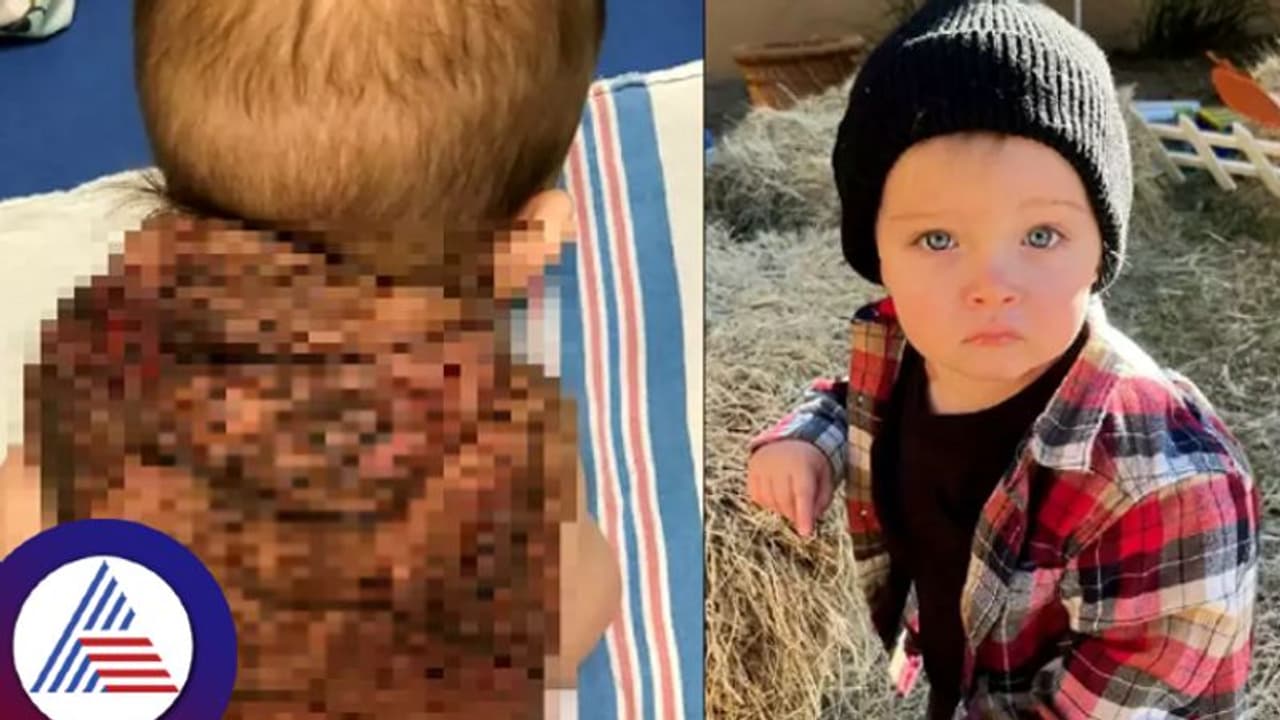 ಆಮೆಯಂತೆ ಮಗುವಿನ ಬೆನ್ನ ಮೇಲಿದೆ ಚಿಪ್ಪು, ಇದೆಂಥಾ ವಿಚಿತ್ರ ಕಾಯಿಲೆ!