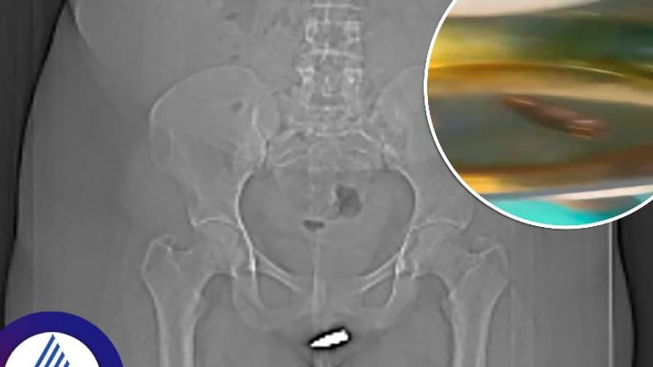 ಮಹಿಳೆ ಗುಪ್ತಾಂಗದಲ್ಲಿತ್ತು ಬುಲೆಟ್, ಒಳಸೇರಿದ್ದು ಹೇಗೆ ಎಂಬುದೇ ವೈದ್ಯರಿಗೆ ಅಚ್ಚರಿ! ಮಹಿಳೆ ಗುಪ್ತಾಂಗದಲ್ಲಿತ್ತು ಬುಲೆಟ್, ಒಳಸೇರಿದ್ದು ಹೇಗೆ ಎಂಬುದೇ ವೈದ್ಯರಿಗೆ ಅಚ್ಚರಿ!