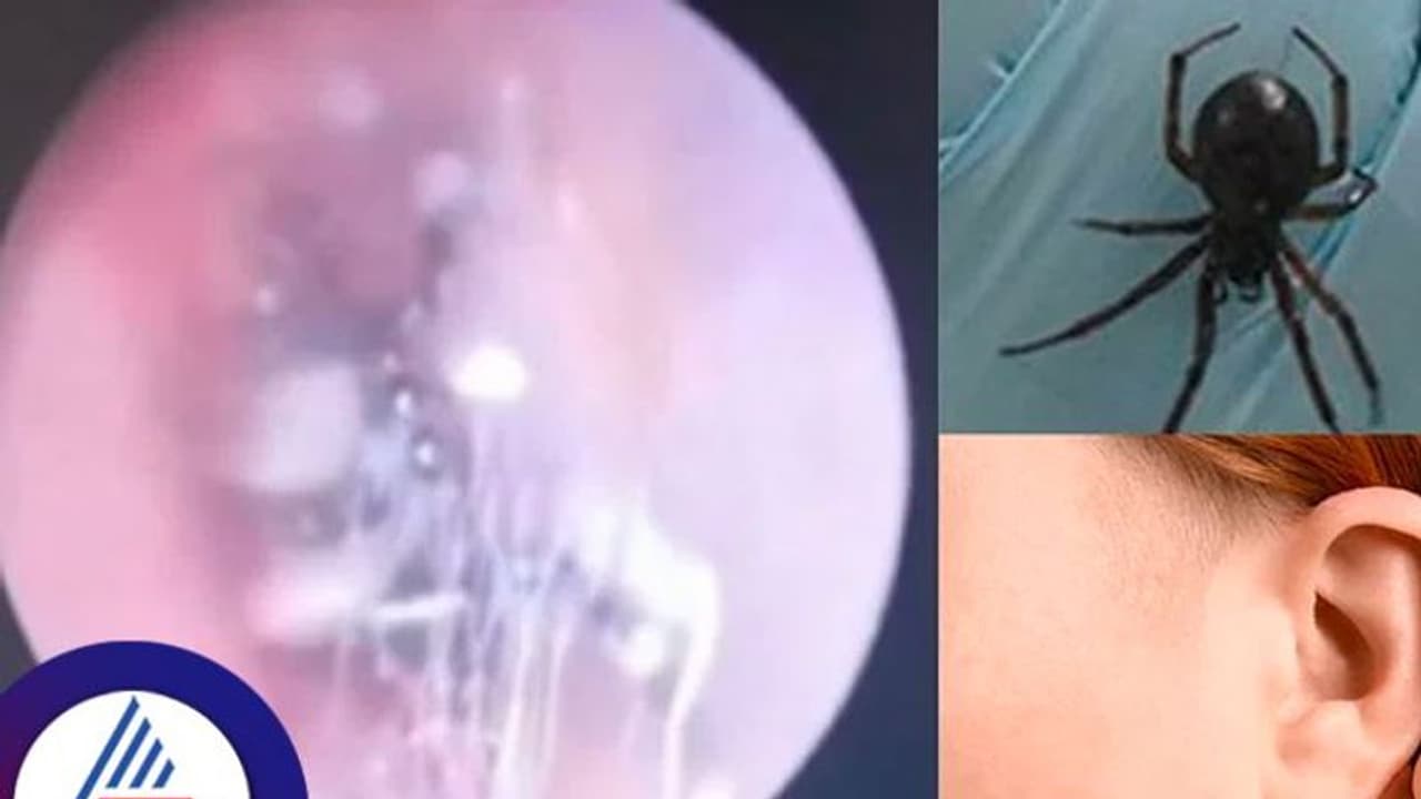 ಮಹಿಳೆಯ ಕಿವಿಯೊಳಗಿತ್ತು ರಾಶಿ ಜೇಡದ ಮರಿಗಳು, ಪರೀಕ್ಷಿಸಿದ ವೈದ್ಯರಿಗೆ ಶಾಕ್..!