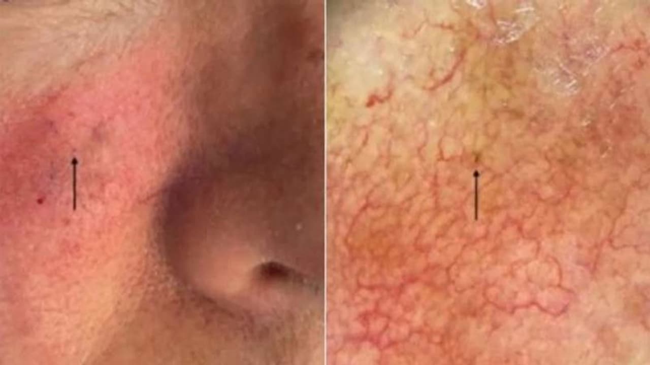 ഈ ചെറിയ ചുവന്ന കുത്ത് സ്കിൻ കാൻസറിന്റെതെന്ന് ഡോക്ടർമാർ കണ്ടെത്തി, ഒടുവിൽ ഗിന്നസ് ബുക്കില് ഇടംപിടിച്ചു ഈ ചെറിയ ചുവന്ന കുത്ത് സ്കിൻ കാൻസറിന്റെതെന്ന് ഡോക്ടർമാർ കണ്ടെത്തി, ഒടുവിൽ ഗിന്നസ് ബുക്കില് ഇടംപിടിച്ചു