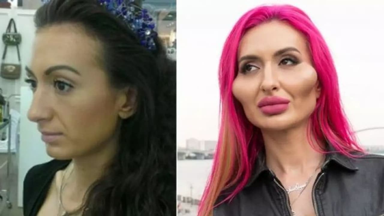 ಪ್ಲಾಸ್ಟಿಕ್ ಸರ್ಜರಿ ಎಫೆಕ್ಟ್ : ಹೇಗಿದ್ದೋಳು ಹೇಗಾದ್ಲು ನೋಡಿ... 