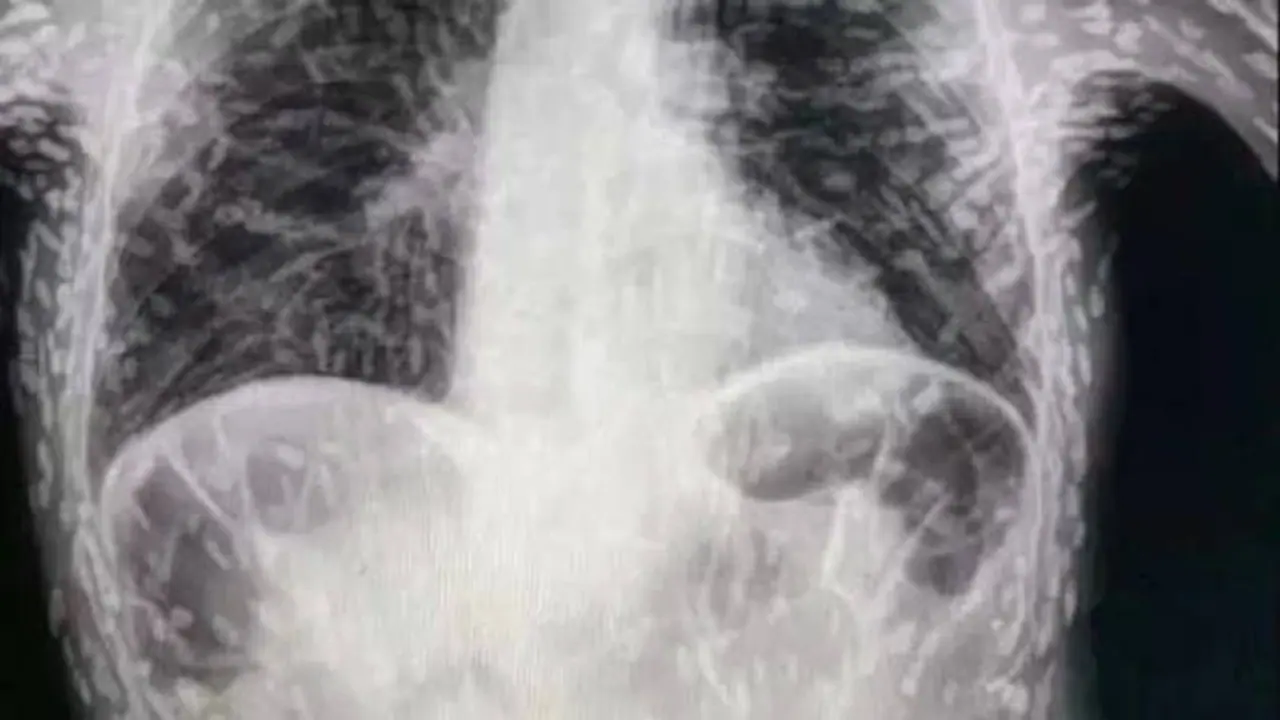 பல ஆண்டுகளாக தொடர் இருமலால் அவதிப்பட்டு வந்த நபர்.. X Ray ஸ்கேனை பாரத்து அதிர்ந்து போன மருத்துவர்கள்.. பல ஆண்டுகளாக தொடர் இருமலால் அவதிப்பட்டு வந்த நபர்.. X Ray ஸ்கேனை பாரத்து அதிர்ந்து போன மருத்துவர்கள்..