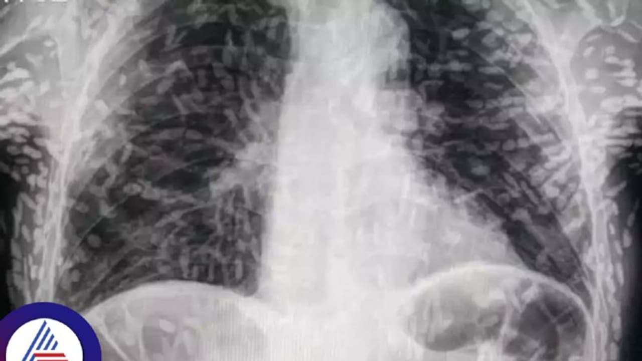 ವಿಪರೀತ ಕೆಮ್ಮೆಂದು ಆಸ್ಪತ್ರೆಗೆ ಹೋದ ವ್ಯಕ್ತಿ, ಸ್ಕ್ಯಾನ್ ಮಾಡಿದಾಗ ದೇಹ ಪೂರ್ತಿ ಹುಳುಗಳು! ವಿಪರೀತ ಕೆಮ್ಮೆಂದು ಆಸ್ಪತ್ರೆಗೆ ಹೋದ ವ್ಯಕ್ತಿ, ಸ್ಕ್ಯಾನ್ ಮಾಡಿದಾಗ ದೇಹ ಪೂರ್ತಿ ಹುಳುಗಳು!