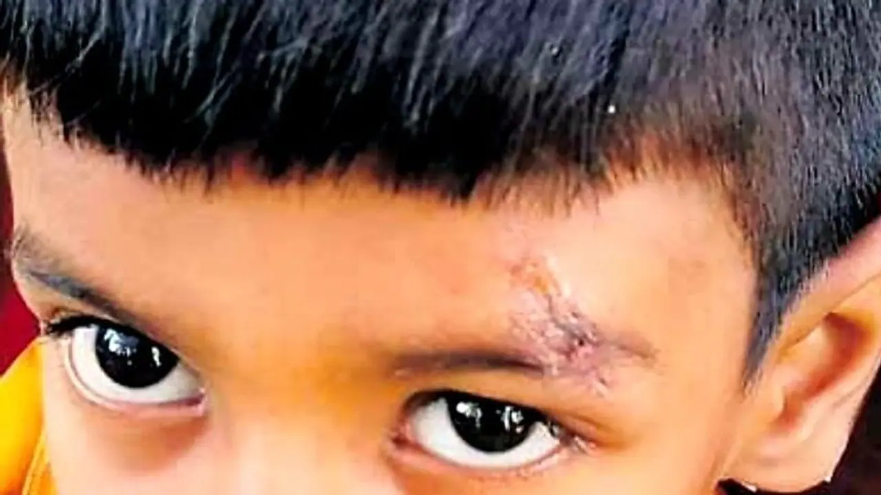 ಗಾಯಕ್ಕೆ ಹೊಲಿಗೆ ಹಾಕುವ ಬದಲು ಫೆವಿಕ್ವಿಕ್ ಹಾಕಿದ ತೆಲಂಗಾಣದ ವೈದ್ಯ! ಗಾಯಕ್ಕೆ ಹೊಲಿಗೆ ಹಾಕುವ ಬದಲು ಫೆವಿಕ್ವಿಕ್ ಹಾಕಿದ ತೆಲಂಗಾಣದ ವೈದ್ಯ!