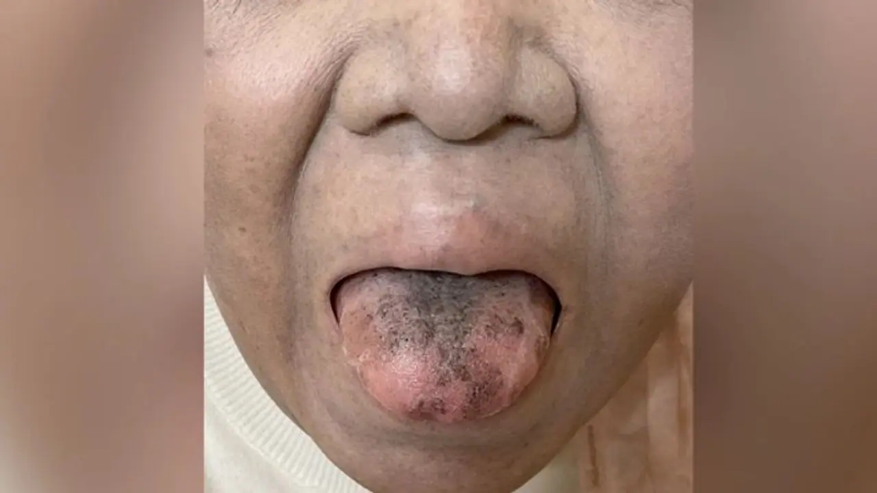 ആന്റിബയോട്ടിക്സ് കഴിച്ചതിന്റെ ഭാഗമായി നാവിന് സംഭവിച്ചത്; സ്ത്രീയുടെ അനുഭവം ശ്രദ്ധിക്കപ്പെടുന്നു ആന്റിബയോട്ടിക്സ് കഴിച്ചതിന്റെ ഭാഗമായി നാവിന് സംഭവിച്ചത്; സ്ത്രീയുടെ അനുഭവം ശ്രദ്ധിക്കപ്പെടുന്നു