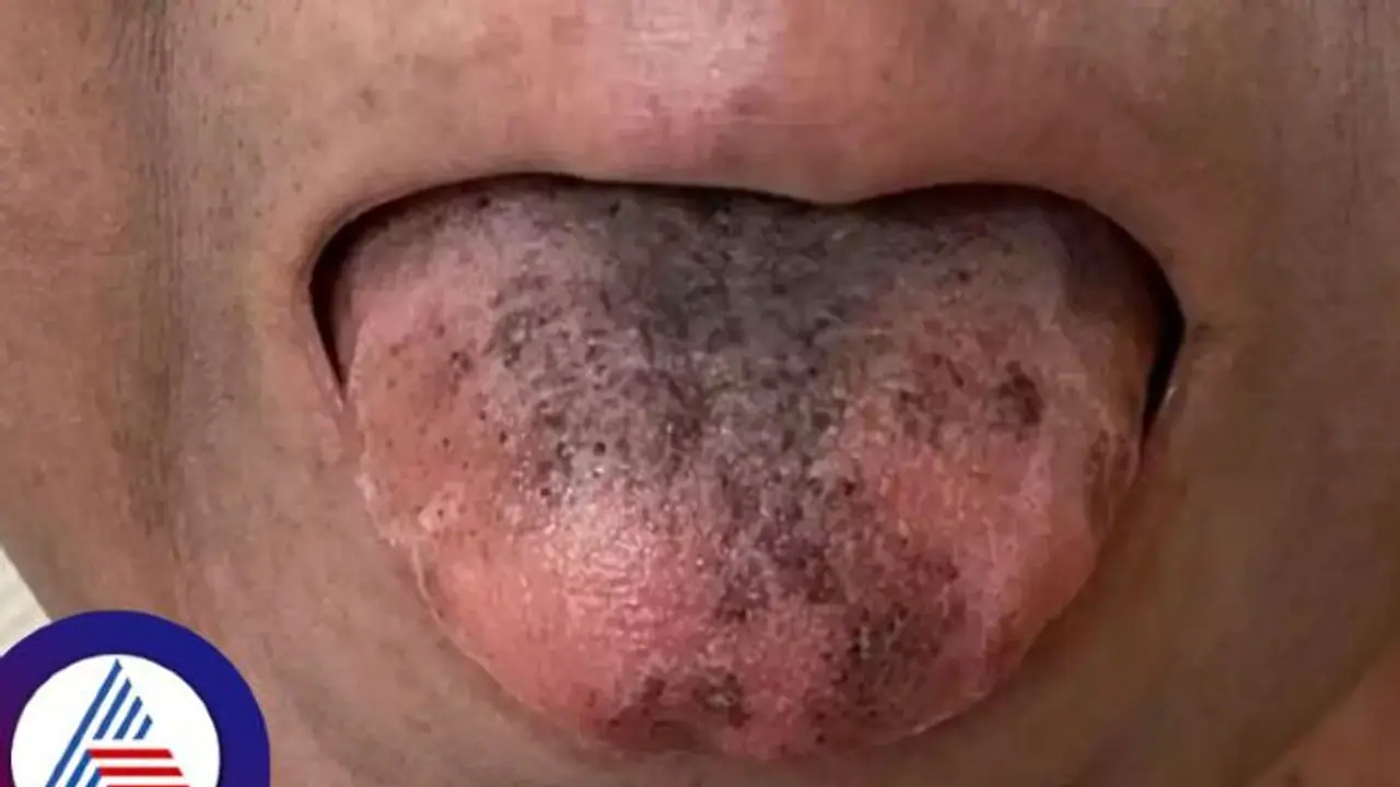 ಮೆಡಿಸಿನ್ ತಿಂದು ಎಡವಟ್ಟಾಯ್ತು, ಮಹಿಳೆಯ ನಾಲಿಗೆ ಮೇಲೆ ಬೆಳೀತು ಕಪ್ಪು ಕೂದಲು! ಮೆಡಿಸಿನ್ ತಿಂದು ಎಡವಟ್ಟಾಯ್ತು, ಮಹಿಳೆಯ ನಾಲಿಗೆ ಮೇಲೆ ಬೆಳೀತು ಕಪ್ಪು ಕೂದಲು!