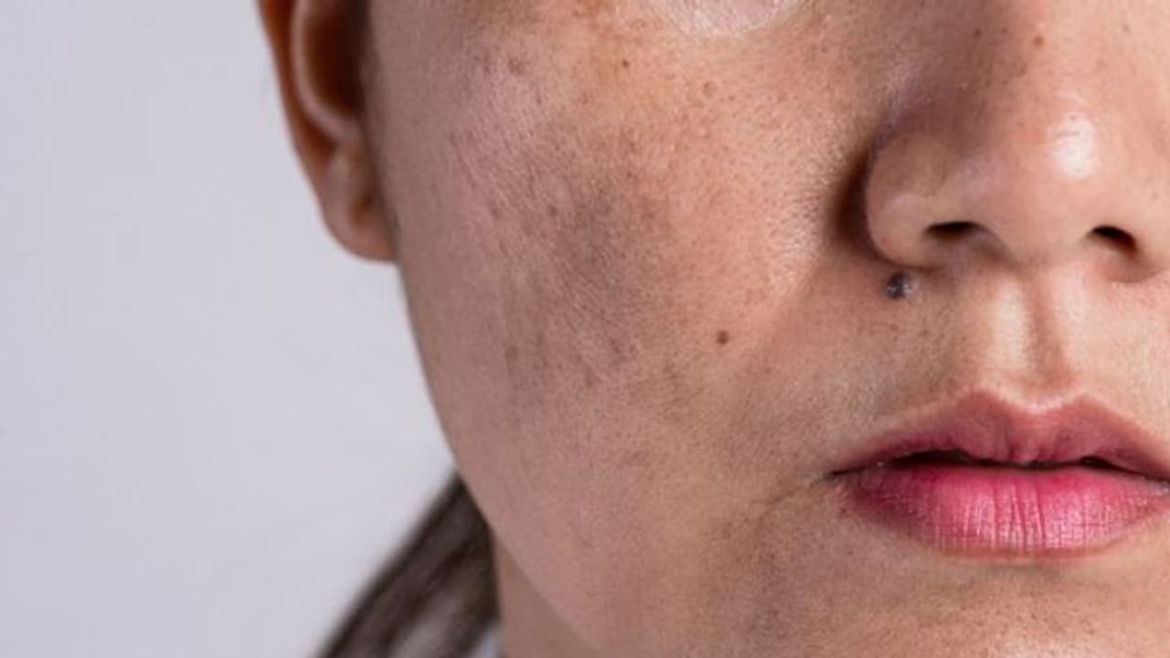 മാമ്പഴം, പപ്പായ, ഓറഞ്ച്; മുഖത്തെ കറുത്ത പാടുകളെ അകറ്റാന് ഇങ്ങനെ ഉപയോഗിക്കാം... മാമ്പഴം, പപ്പായ, ഓറഞ്ച്; മുഖത്തെ കറുത്ത പാടുകളെ അകറ്റാന് ഇങ്ങനെ ഉപയോഗിക്കാം...