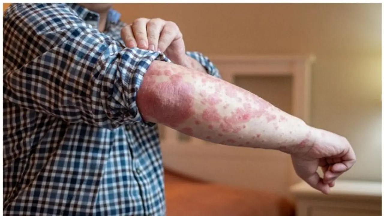 സോറിയാസിസ് രോഗം നേരത്തെ തിരിച്ചറിയാം ; ശ്രദ്ധിക്കേണ്ടത്... സോറിയാസിസ് രോഗം നേരത്തെ തിരിച്ചറിയാം ; ശ്രദ്ധിക്കേണ്ടത്...