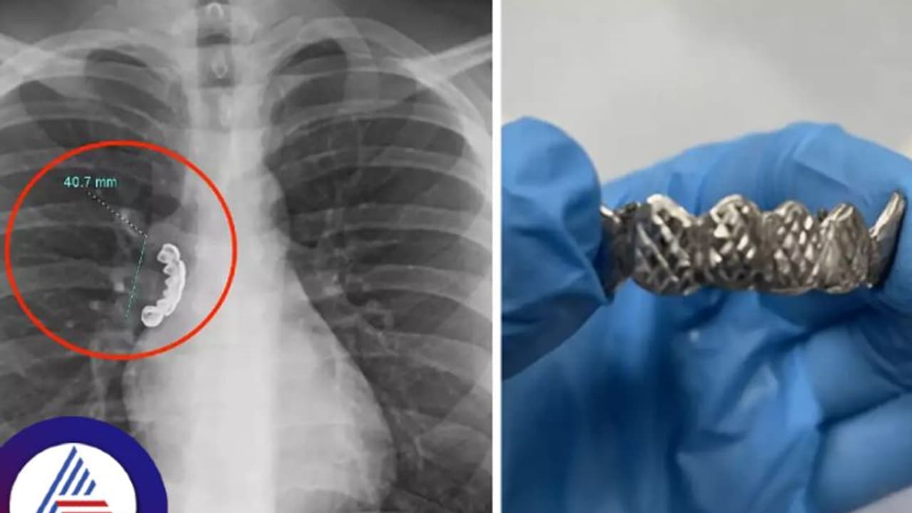 ಅಯ್ಯಯ್ಯೋ...ಹಲ್ಲಿನ ಸೆಟ್ನ್ನೇ ನುಂಗಿಬಿಟ್ನಲ್ಲಪ್ಪಾ, ಆಮೇಲೆ ಆಗಿದ್ದೇನು? ಅಯ್ಯಯ್ಯೋ...ಹಲ್ಲಿನ ಸೆಟ್ನ್ನೇ ನುಂಗಿಬಿಟ್ನಲ್ಲಪ್ಪಾ, ಆಮೇಲೆ ಆಗಿದ್ದೇನು?