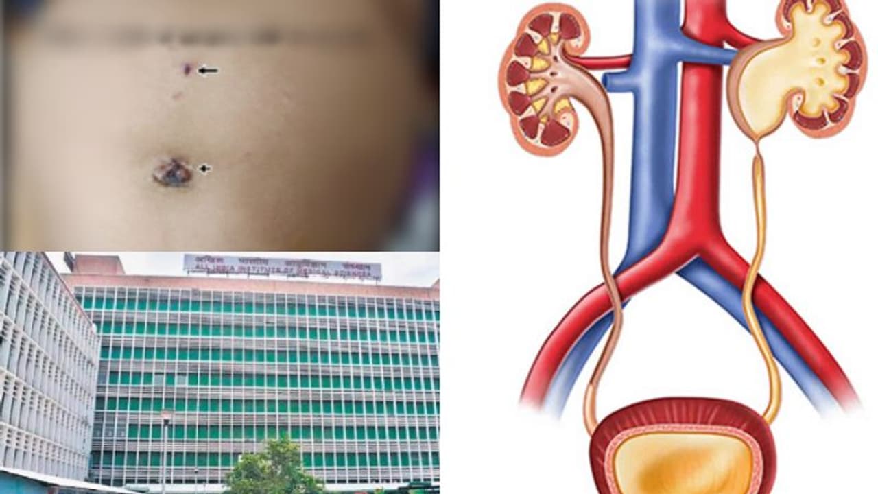 മൂന്ന് മാസം പ്രായമുള്ള കുഞ്ഞിന് മൂത്രതടസം, ജന്മനാ ഉള്ള അവസ്ഥ; അത്യപൂർവ്വ ശസ്ത്രക്രിയ വിജയം, ലോക റെക്കോർഡ്!