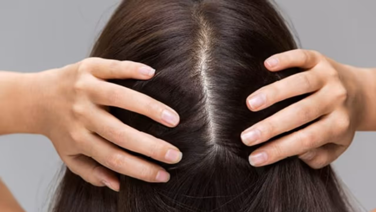 താരനും തലമുടി കൊഴിച്ചിലും തടയാനും മുടി വളരാനും അടുക്കളയിലുള്ള ഈ ഒറ്റ ചേരുവ മാത്രം മതി! 