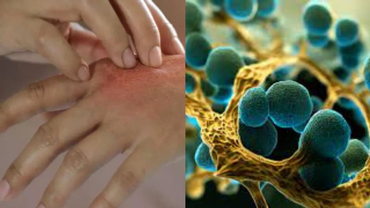 ഉയര്ന്ന വ്യാപനശേഷിയുള്ള ഫംഗല് രോഗം അമേരിക്കയില് സ്ഥിരീകരിച്ചു; ജാഗ്രത നിര്ദേശം ഉയര്ന്ന വ്യാപനശേഷിയുള്ള ഫംഗല് രോഗം അമേരിക്കയില് സ്ഥിരീകരിച്ചു; ജാഗ്രത നിര്ദേശം