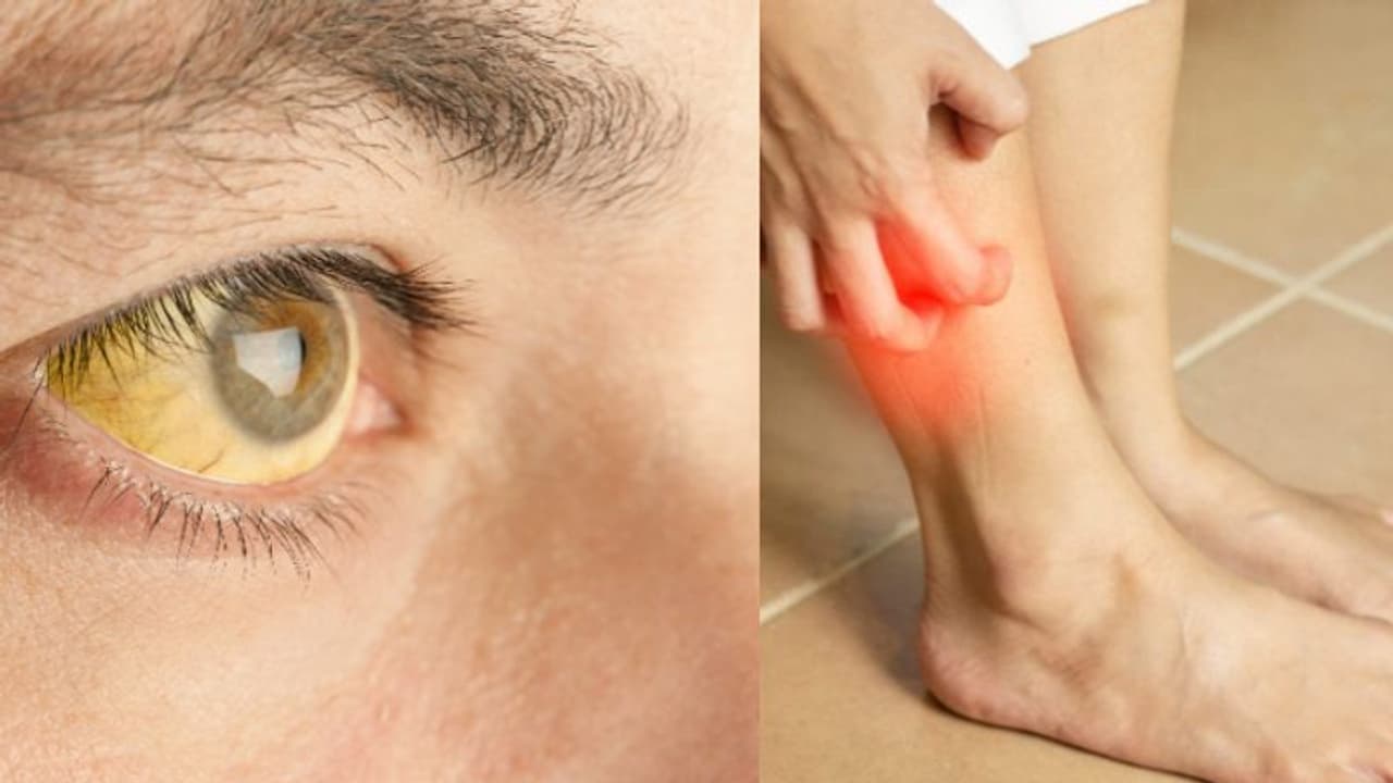 കണ്ണിന് മഞ്ഞനിറം, ചര്മ്മം ചൊറിയുക; അവഗണിക്കരുത് ഈ ലക്ഷണങ്ങളെ... കണ്ണിന് മഞ്ഞനിറം, ചര്മ്മം ചൊറിയുക; അവഗണിക്കരുത് ഈ ലക്ഷണങ്ങളെ...