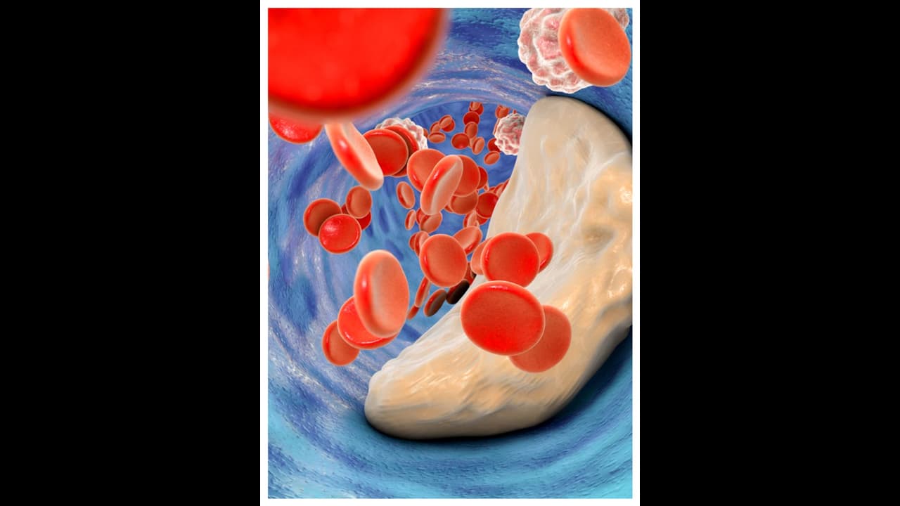 ഉയർന്ന കൊളസ്ട്രോൾ ; ശ്രദ്ധിക്കാതെ പോകുന്ന നാല് ലക്ഷണങ്ങൾ ഉയർന്ന കൊളസ്ട്രോൾ ; ശ്രദ്ധിക്കാതെ പോകുന്ന നാല് ലക്ഷണങ്ങൾ