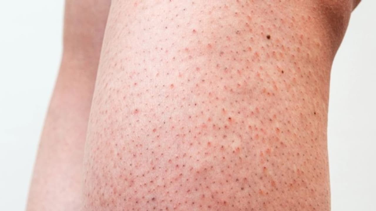 ഇങ്ങനെ ചെറിയ പുള്ളികള് തൊലിയില് ഉണ്ടോ? മാറാൻ ചെയ്യേണ്ടത്... ഇങ്ങനെ ചെറിയ പുള്ളികള് തൊലിയില് ഉണ്ടോ? മാറാൻ ചെയ്യേണ്ടത്...